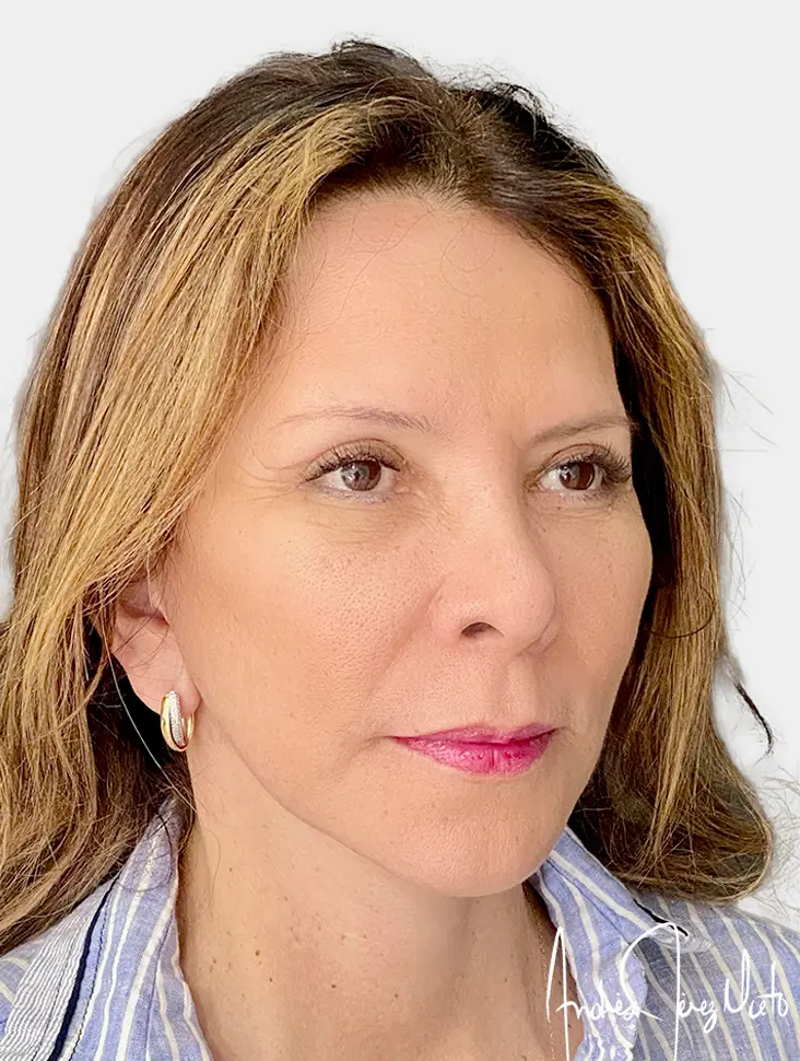 Resultado 2 - Después